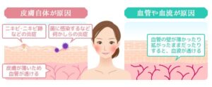 皮膚自体が原因や血管や血流が原因のイラスト